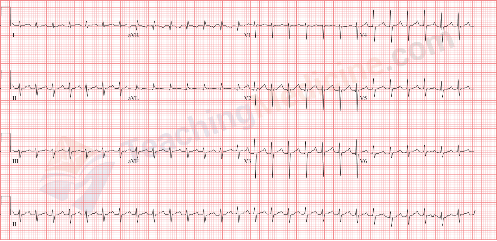 12 Lead Ecg Sinus Tachycardia 